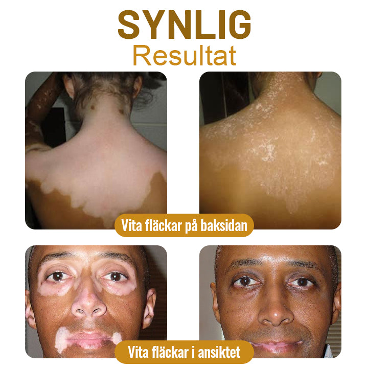 Dobshow™ BeeVenom Vitiligo Treatment Cream