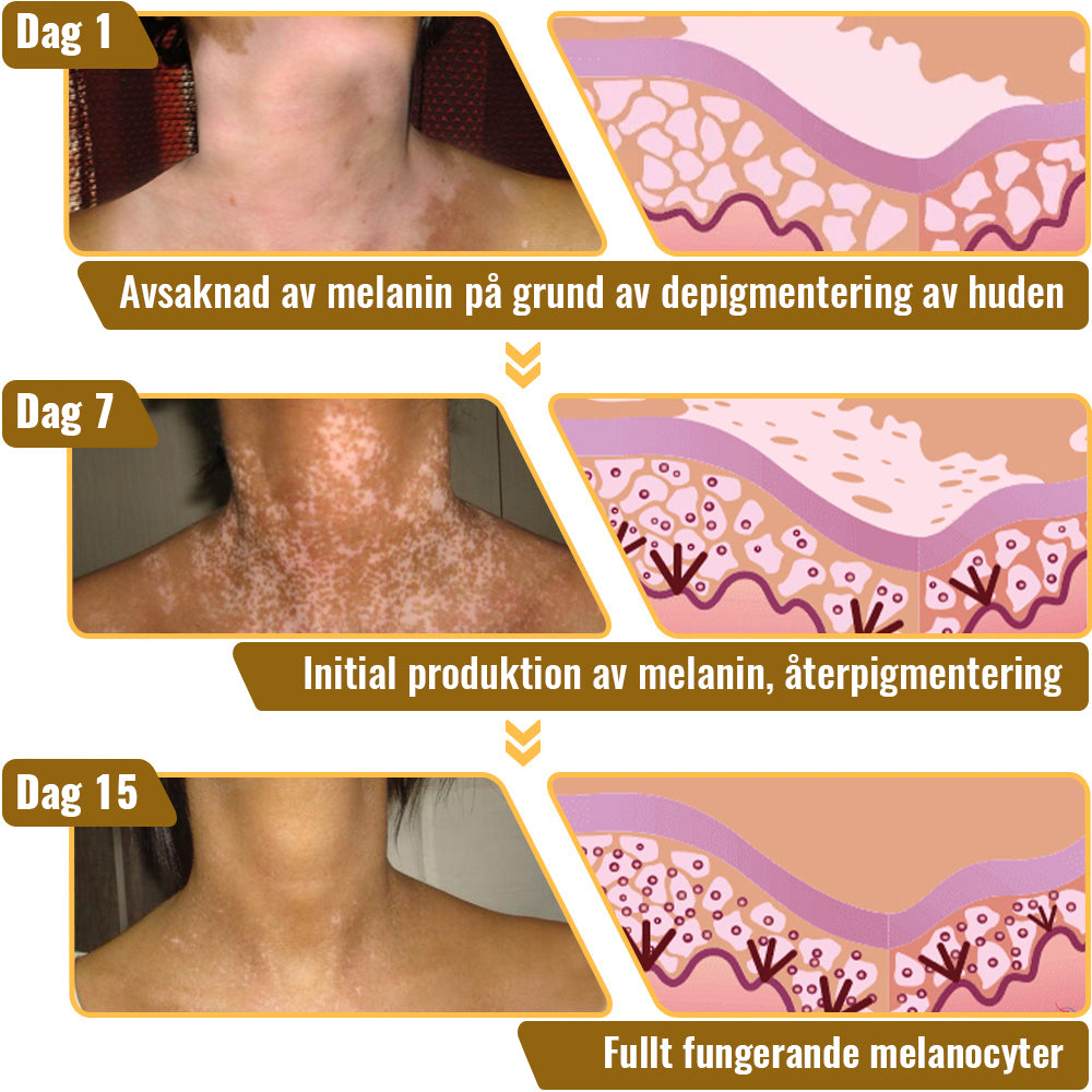 Dobshow™ BeeVenom Vitiligo Treatment Cream