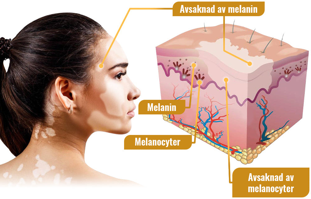 Dobshow™ BeeVenom Vitiligo Treatment Cream