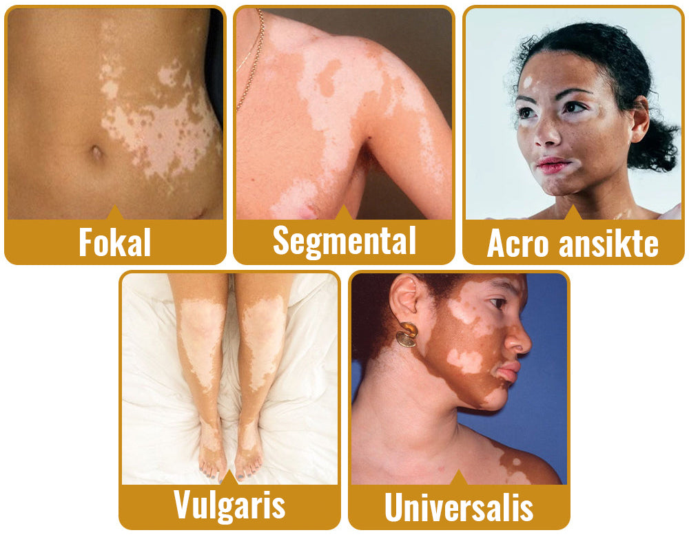 Dobshow™ BeeVenom Vitiligo Treatment Cream